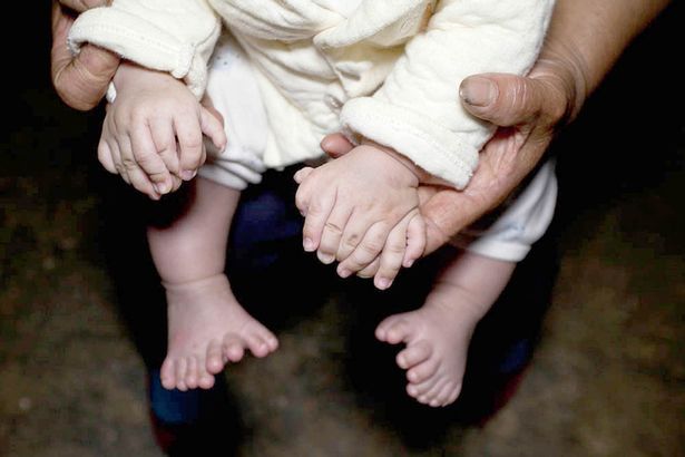 PAY-Hong-Hong-baby-born-with-15-fingers-and-16-toes