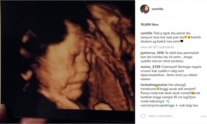 Bayi Sam & Syatilla Tersenyum Ketika Ultrasound